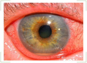 Иридоциклит глаза