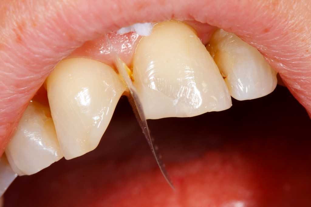 Наращивание зубов