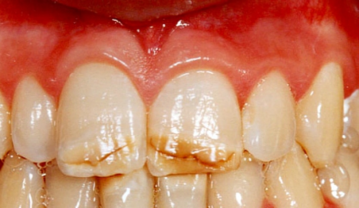 Трещины на зубах: чем опасны, как распознать