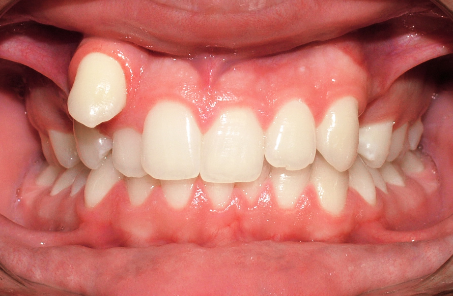Аномалия зубов