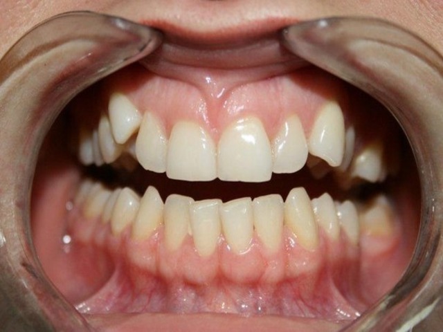 Что такое ретинированные и дистопированные зубы?