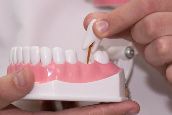 Дефект зуба клиновидный