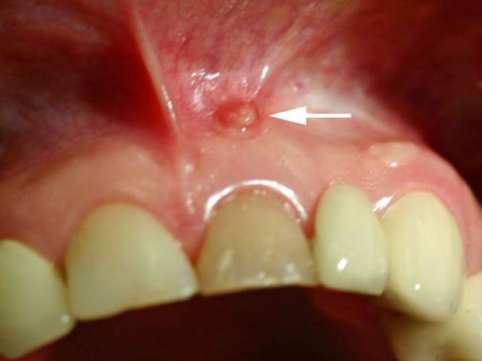 Уплотнения и шишки на деснах после удаления зуба