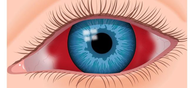 Гемофтальм глаза