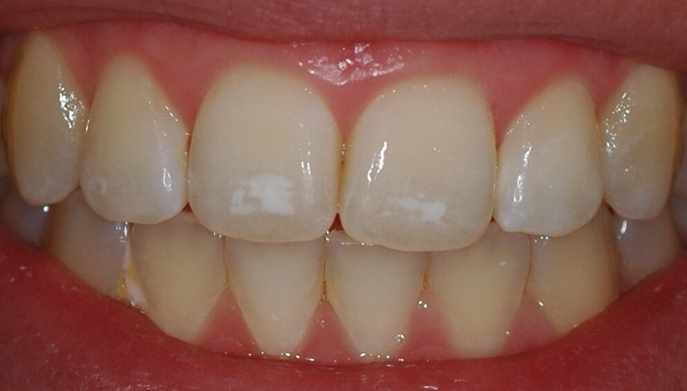 Белые пятна на зубах
