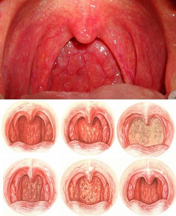 Изменение слизистой горла при ангине