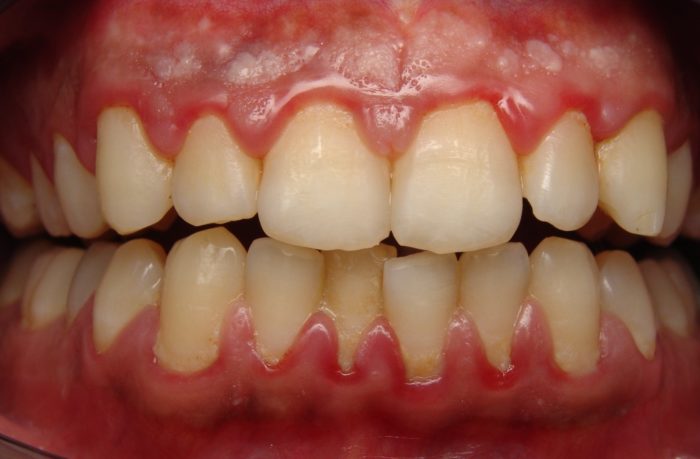 Антибиотик при воспалении зубов и десен