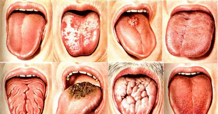 Опасно ли воспаление языка (глоссит)?