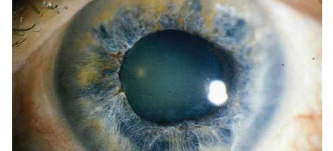 Открытоугольная глаукома