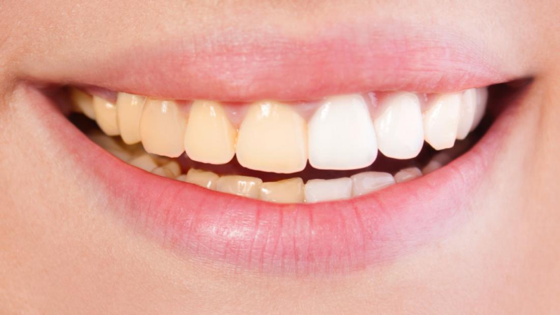 Почему желтеют зубы и как с этим бороться?