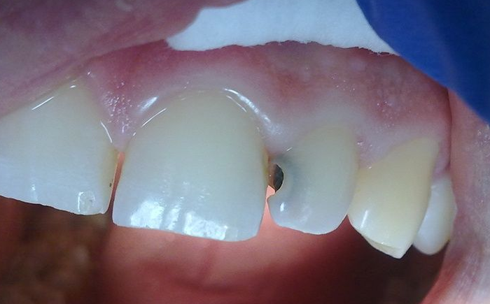 Что делать, если появился кариес на передних зубах?