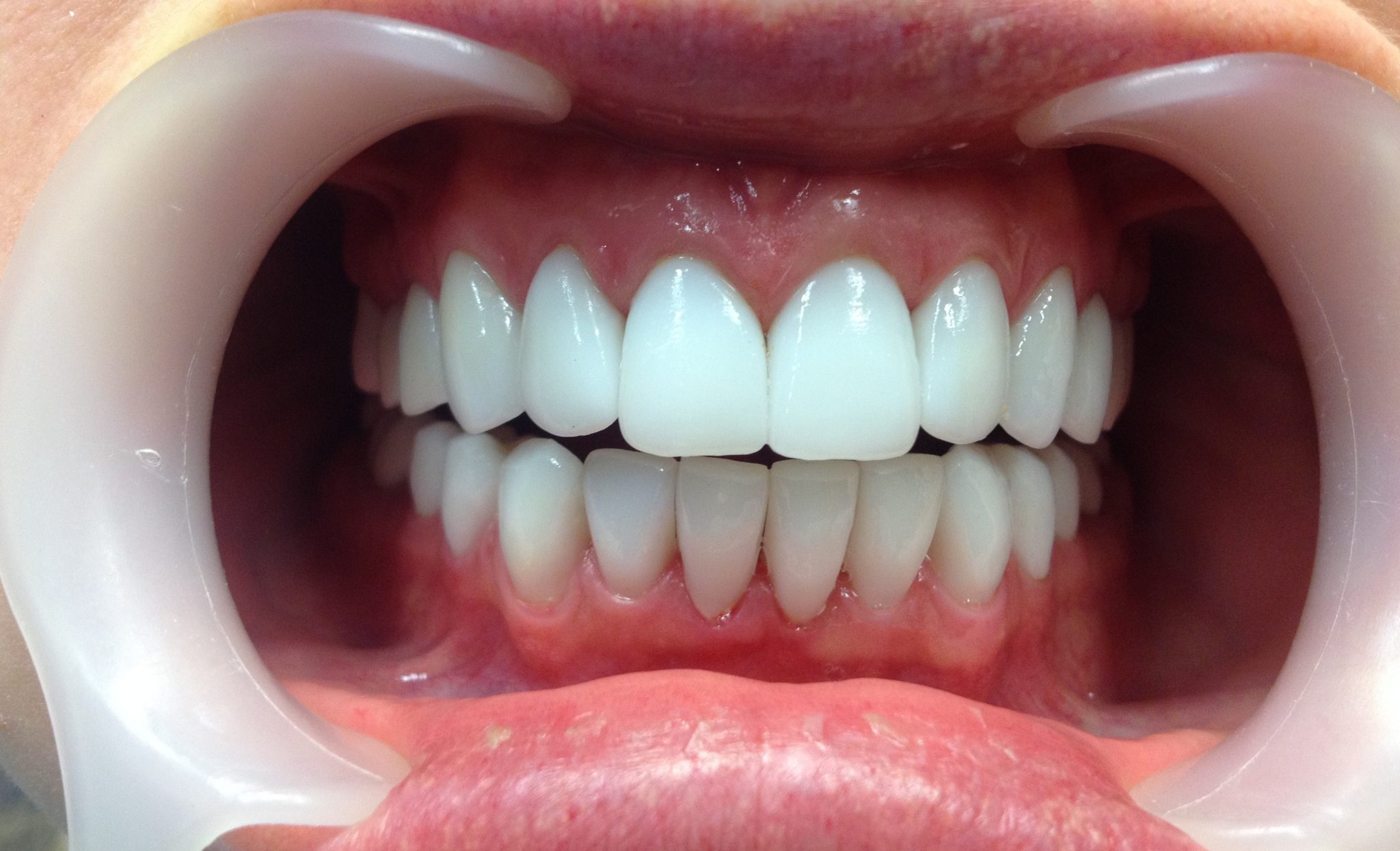 Особенности протезирования без обточки зубов