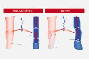 варикозное расширение вен нижних конечностей болезнь лечение симптомы