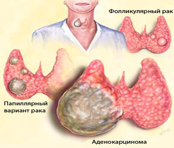 опухоль щитовидки