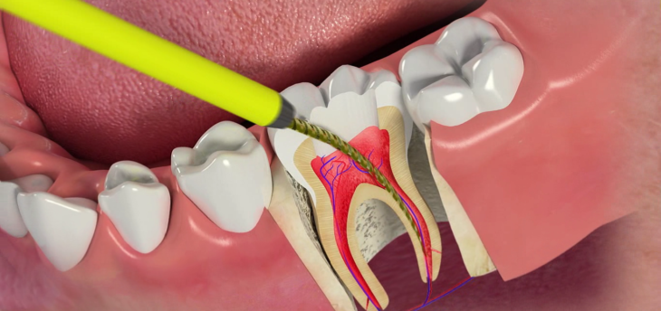 Депульпирование зуба перед протезированием