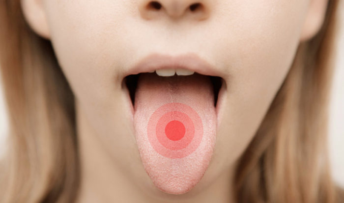 Почему под языком появляются болячки и язвочки?