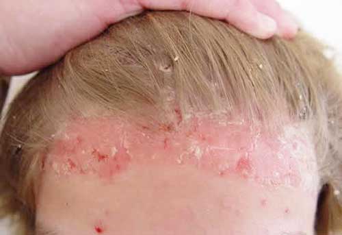 Эритема - отшелушивние кожи в волосяной части