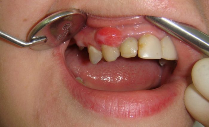 По каким причинам может появиться свищ после удаления зуба?