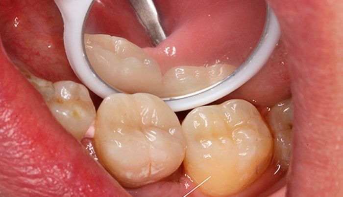 Болит зуб после лечения