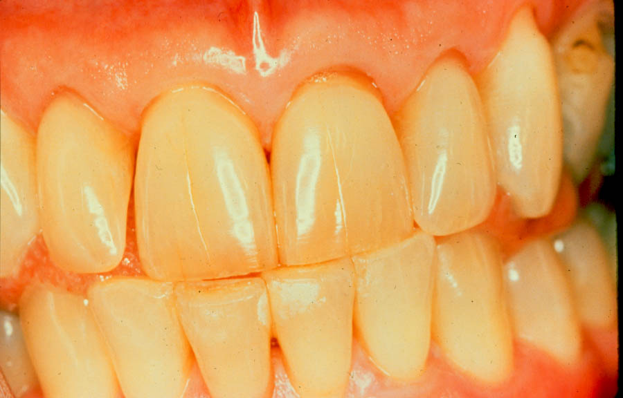 Почему желтеют зубы и как с этим бороться?