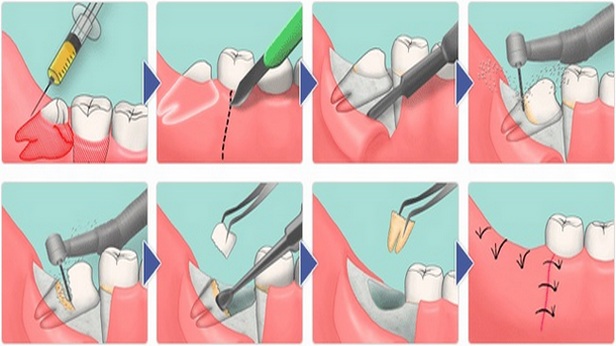Через сколько рассасываются швы после удаления зуба