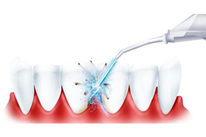 Узнаем, как правильно почистить зубные протезы