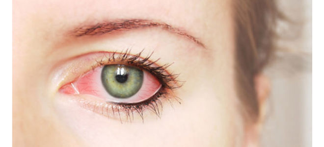 Почему краснеют глаза от линз?