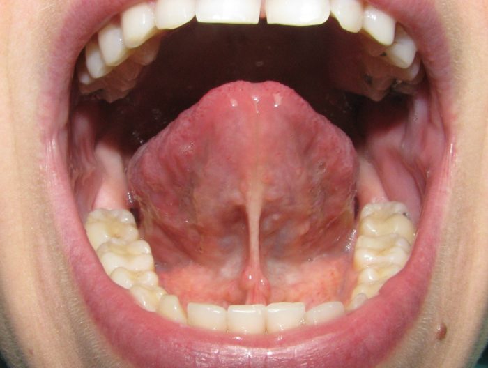 Возникла боль под языком — причины и способы лечения. Болит под языком: что делать