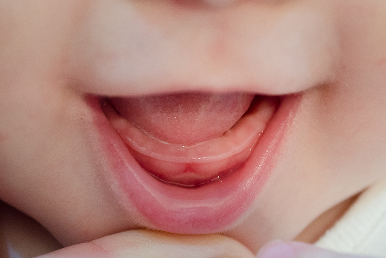 6 признаки зубов. Десна при прорезывании зубов. Прорезание первых зубов. Десны у новорожденных при прорезывании зубов.