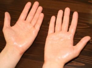 советы по уходу за кожей рук при потливости