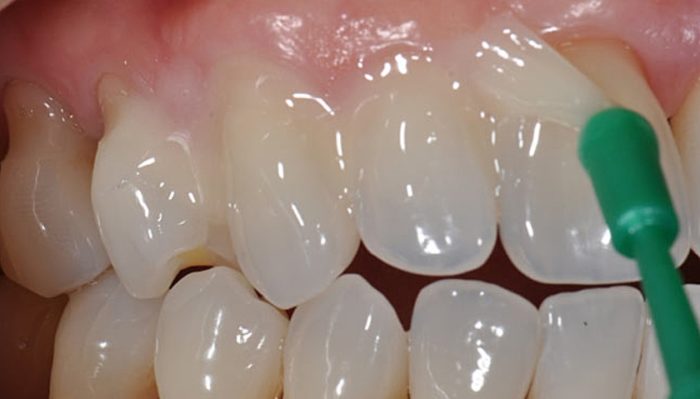 Как укрепить эмаль зубов
