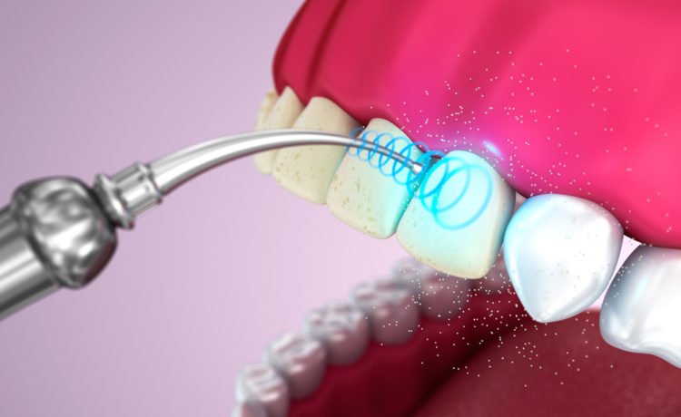Как отбелить зубы