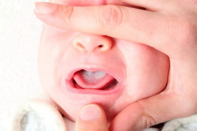 Детский кандидозный стоматит: его симптомы и признаки