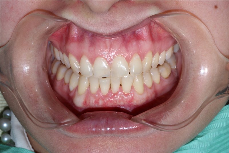 Остеогенная саркома челюсти: симптомы