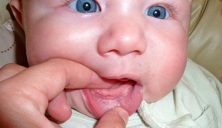 Могут ли быть запор у ребенка когда режутся зубы thumbnail