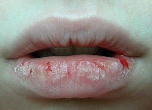От чего трескаются губы: причины и профилактика