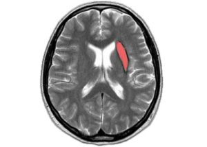 Ретроцеребеллярная киста головного мозга: диагностика и лечение