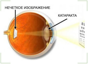 Осложненная катаракта