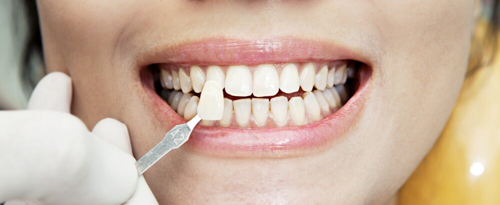 Как осуществляется протезирование зубов?