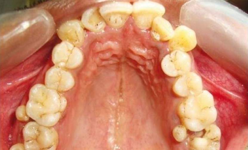 аномалии зубов