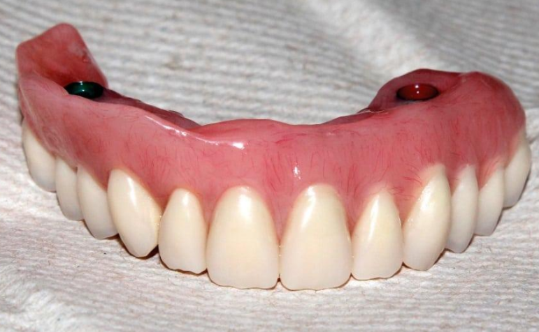 Полносъемный протез верхней челюсти. Зубной протез на верхнюю челюсть. Съёмный протез на верхнюю челюсть. Верхний съемный зубной протез.