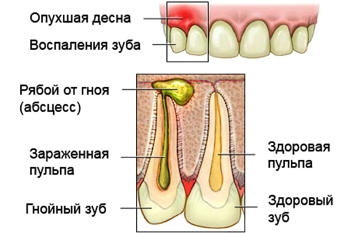 Температура после лечения зуба. Пульпит Гнойный (пульпарный абсцесс. Пародонтальный абсцесс.