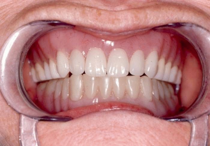 Преимущества и недостатки акриловых зубных протезов