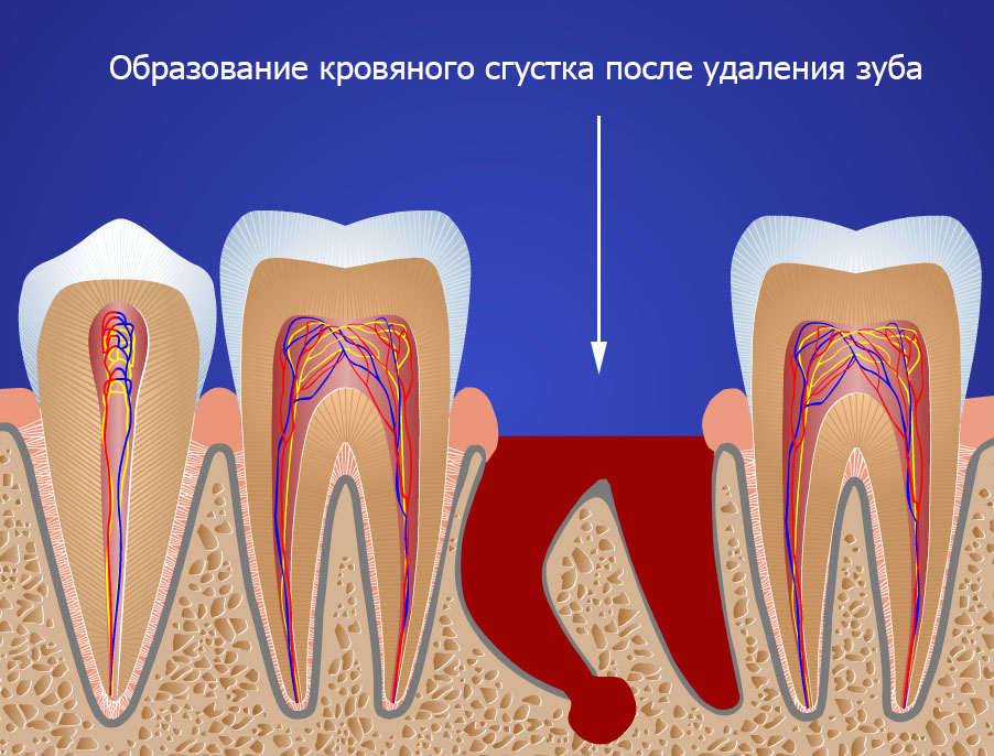 Как остановить кровь после удаления зуба