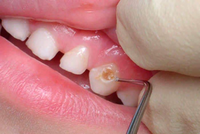 Ставят ли пломбы на молочные зубы