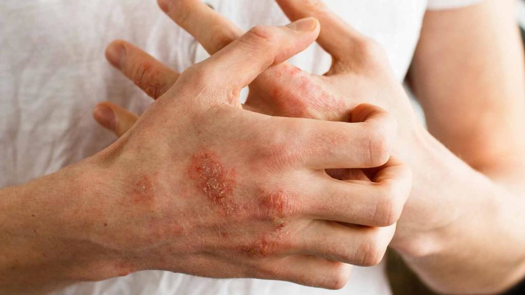 Натуральные средства лечения трещин на коже рук
