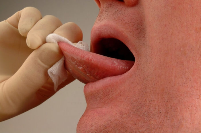 Болит уздечка под языком - причины и методы лечения воспаления