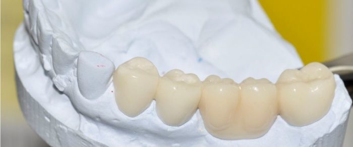 Для чего нужны временные зубные протезы