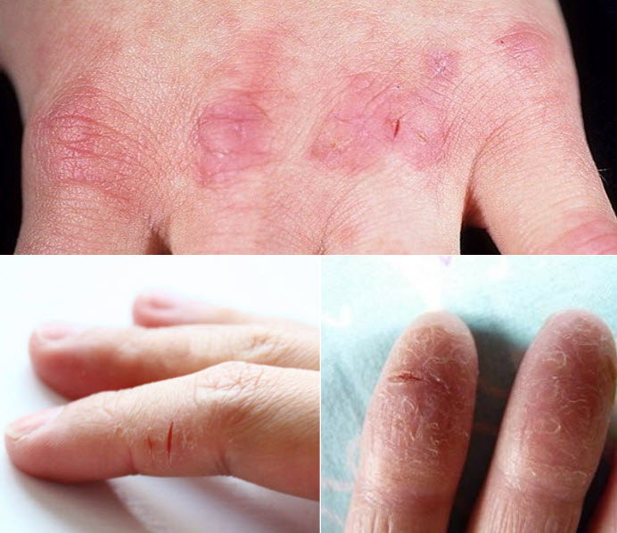 Натуральные средства лечения трещин на коже рук