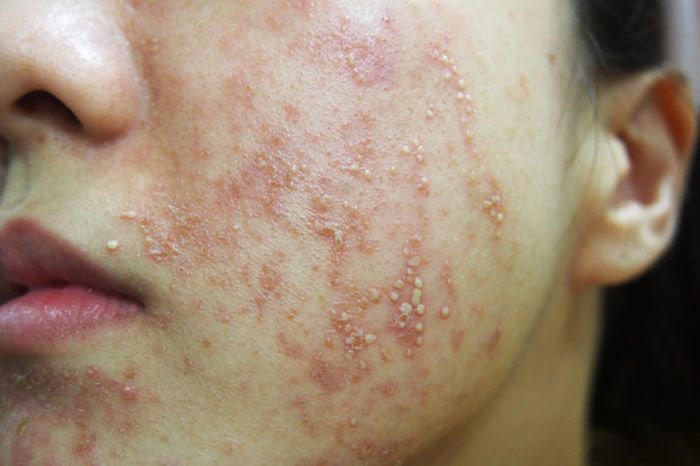 аллергия на лице от крема